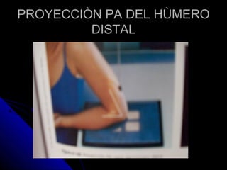 PROYECCIÒN PA DEL HÙMEROPROYECCIÒN PA DEL HÙMERO
DISTALDISTAL
 