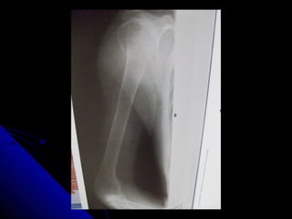 Antebrazo, codo y humero