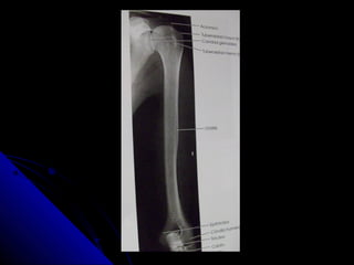 Antebrazo, codo y humero