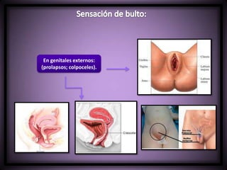 En genitales externos:
(prolapsos; colpoceles).
 