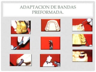 ADAPTACION DE BANDAS
PREFORMADA.
 