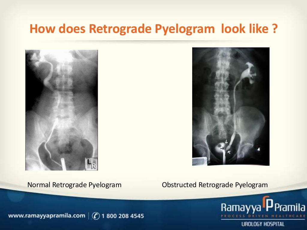 Antegrade and retrograde pyelography