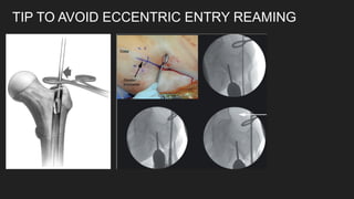 ANTEGRADE FEMUR NAILING - SURGICAL TECHNIQUES.pptx