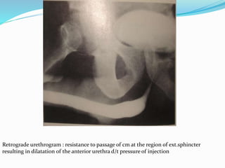 Retrograde urethrogram : resistance to passage of cm at the region of ext.sphincter
resulting in dilatation of the anterior urethra d/t pressure of injection
 