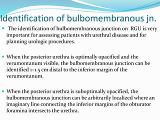 Identification of bulbomembranous jn.
 The identification of bulbomembranous junction on RGU is very
important for assessing patients with urethral disease and for
planning urologic procedures.
 When the posterior urethra is optimally opacified and the
verumontanum visible, the bulbomembranous junction can be
identified 1–1.5 cm distal to the inferior margin of the
verumontanum.
 When the posterior urethra is suboptimally opacified, the
bulbomembranous junction can be arbitrarily localized where an
imaginary line connecting the inferior margins of the obturator
foramina intersects the urethra.
 