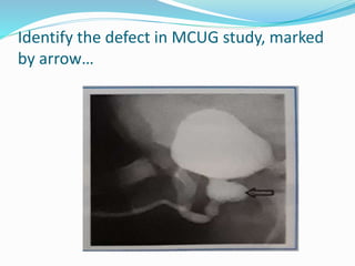 Identify the defect in MCUG study, marked
by arrow…
 