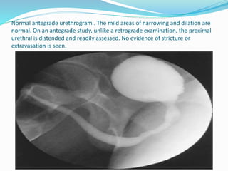  Best investigation for Vesico ureteric reflux ?
a. IVU
b. MCU
c. retrograde pyelogram
d. RGU
 