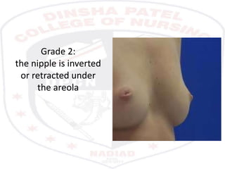 Grade 2:
the nipple is inverted
or retracted under
the areola
 