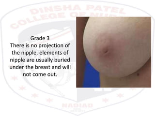 Grade 3
There is no projection of
the nipple, elements of
nipple are usually buried
under the breast and will
not come out.
 