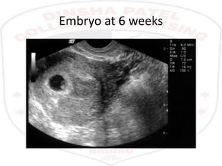 Embryo at 6 weeks
 