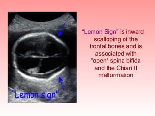 Antenatal assessment,fetal well being | PPT