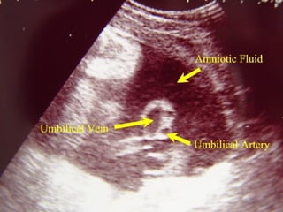 Antenatal assessment,fetal well being Slide 55