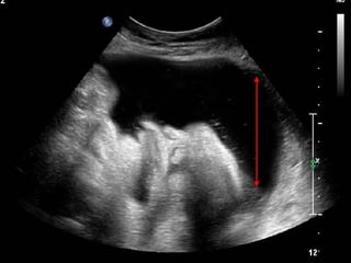 Antenatal assessment,fetal well being Slide 58