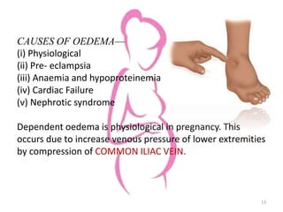 CAUSES OF OEDEMA—
(i) Physiological
(ii) Pre- eclampsia
(iii) Anaemia and hypoproteinemia
(iv) Cardiac Failure
(v) Nephrotic syndrome
Dependent oedema is physiological in pregnancy. This
occurs due to increase venous pressure of lower extremities
by compression of COMMON ILIAC VEIN.
13
 