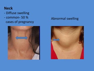 Neck
- Diffuse swelling
- common- 50 %
cases of pregnancy
Abnormal swelling
 