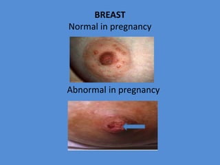 BREAST
Normal in pregnancy
Abnormal in pregnancy
 