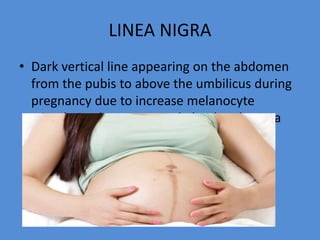 LINEA NIGRA
• Dark vertical line appearing on the abdomen
from the pubis to above the umbilicus during
pregnancy due to increase melanocyte
stimulating hormone made by the placenta
 