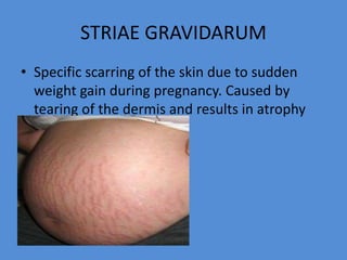 STRIAE GRAVIDARUM
• Specific scarring of the skin due to sudden
weight gain during pregnancy. Caused by
tearing of the dermis and results in atrophy
 