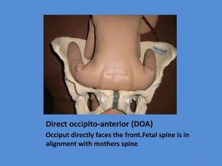 Direct occipito-anterior (DOA)
Occiput directly faces the front.Fetal spine is in
alignment with mothers spine.
49
 