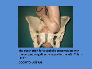 The description for a cephalic presentation with
the occiput lying directly lateral to the left . This is
–LEFT
OCCIPITO-LATERAL
50
 