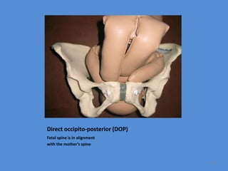 Direct occipito-posterior (DOP)
Fetal spine is in alignment
with the mother’s spine
53
 