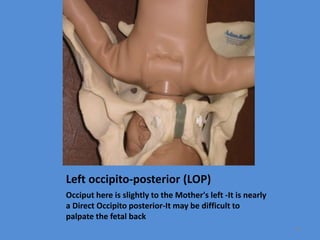 Left occipito-posterior (LOP)
Occiput here is slightly to the Mother's left -It is nearly
a Direct Occipito posterior-It may be difficult to
palpate the fetal back
54
 