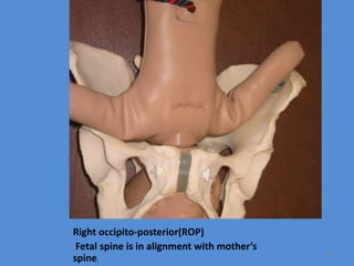 Right occipito-posterior(ROP)
Fetal spine is in alignment with mother’s
spine.
55
 