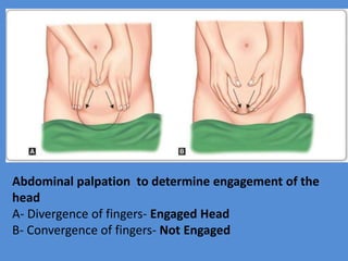 Abdominal palpation to determine engagement of the
head
A- Divergence of fingers- Engaged Head
B- Convergence of fingers- Not Engaged
 