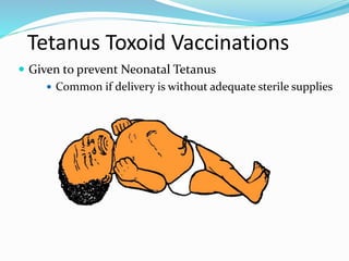 Tetanus Toxoid Vaccinations
 Given to prevent Neonatal Tetanus
 Common if delivery is without adequate sterile supplies
 