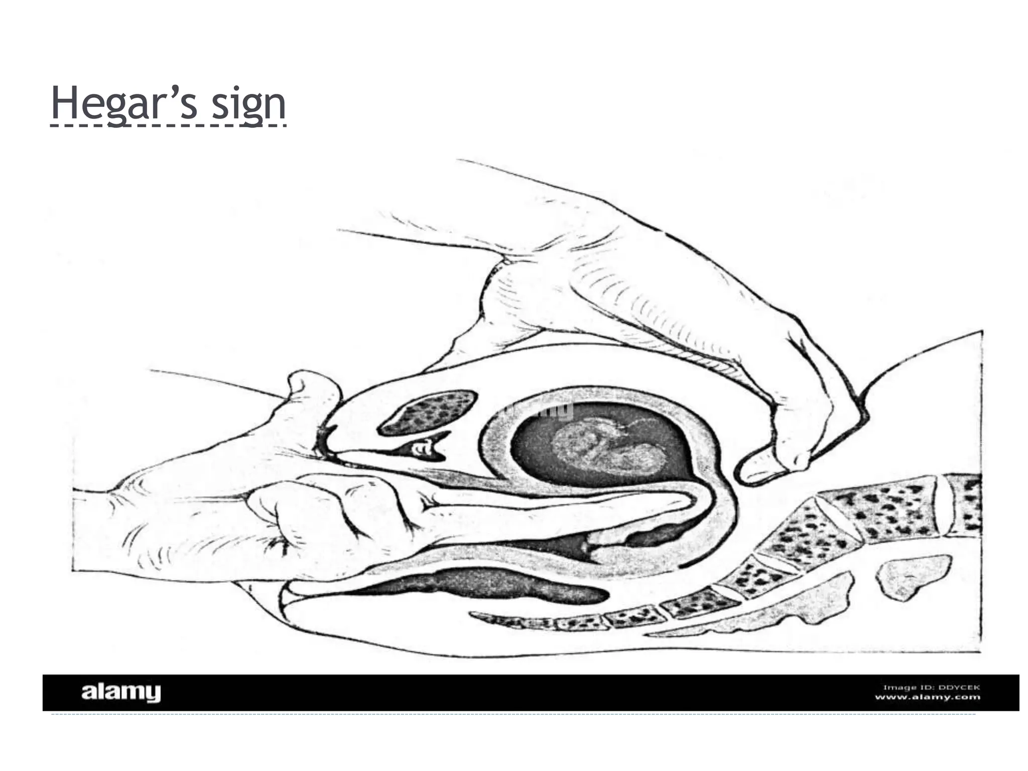 Hegar’s sign
 