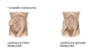 • Leopold’s manoeuvres:
LEOPOLD’S FIRST
MANEUVER
LEOPOLD’S SECOND
MANEUVER
 
