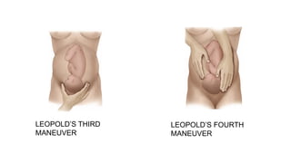 LEOPOLD’S THIRD
MANEUVER
LEOPOLD’S FOURTH
MANEUVER
 