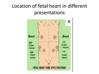 Location of fetal heart in different
          presentations
 