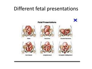 Different fetal presentations
 