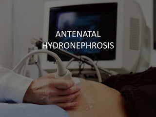ANTENATAL
HYDRONEPHROSIS
 
