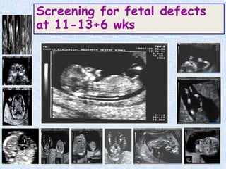Normal anatomy
Screening for fetal defects
at 11-13+6 wks
 