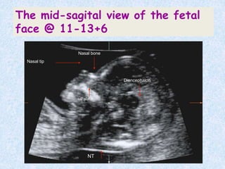 NT
Nasal bone
Nasal tip
Diencephalon
Palate
The mid-sagital view of the fetal
face @ 11-13+6
 