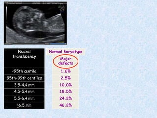 46.2%
>6.5 mm
24.2%
5.5-6.4 mm
18.5%
4.5-5.4 mm
10.0%
3.5-4.4 mm
2.5%
95th-99th centiles
1.6%
<95th centile
Major
defects
Nuchal
translucency
Normal karyotype
 