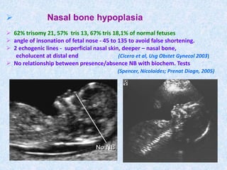  Nasal bone hypoplasia
 62% trisomy 21, 57% tris 13, 67% tris 18,1% of normal fetuses
 angle of insonation of fetal nose - 45 to 135 to avoid false shortening.
 2 echogenic lines - superficial nasal skin, deeper – nasal bone,
echolucent at distal end (Cicero et al, Usg Obstet Gynecol 2003)
 No relationship between presence/absence NB with biochem. Tests
(Spencer, Nicolaides; Prenat Diagn, 2005)
 