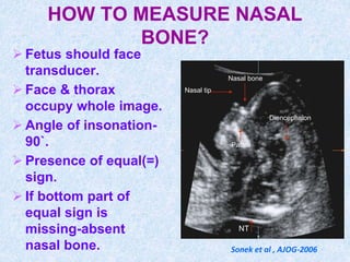 HOW TO MEASURE NASAL
BONE?
 Fetus should face
transducer.
 Face & thorax
occupy whole image.
 Angle of insonation-
90`.
 Presence of equal(=)
sign.
 If bottom part of
equal sign is
missing-absent
nasal bone.
NT
Nasal bone
Nasal tip
Diencephalon
Palate
Sonek et al , AJOG-2006
 