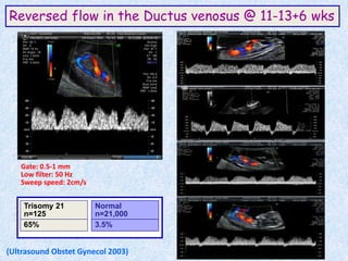 Reversed flow in the Ductus venosus @ 11-13+6 wks
Gate: 0.5-1 mm
Low filter: 50 Hz
Sweep speed: 2cm/s
Contamination from hepatic vein
Contamination from umbilical vein
Trisomy 21
n=125
65%
Normal
n=21,000
3.5%
(Ultrasound Obstet Gynecol 2003)
 
