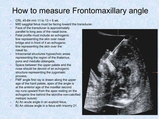 How to measure Frontomaxillary angle
 CRL 45-84 mm 11 to 13 + 6 wk.
 MID saggital fetus must be facing toward the transducer.
 Face of the transducer is approximately
parallel to long axis of the nasal bone.
 Fetal profile must include an echogenic
line representing the skin over nasal
bridge and in front of it an echogenic
line representing the skin over the
nasal tip.
 Intracranial structures hypoechoic areas
representing the region of the thalamus,
pons and medulla oblangata.
 Space between the upper palate and the
nose should be devoid of an echogenic
structure representing the zygomatic
process.
 FMF angle first ray is drawn along the upper
age of the hard palate, apex of the angle is
at the anterior age of the maxillar second
ray runs upward from the apex resting on the
echogenic line behind the skin(the non-calcified
metopic suture)
 A) An acute angle in an euploid fetus.
 B) An obtuse angle in a fetus with trisomy 21
 
