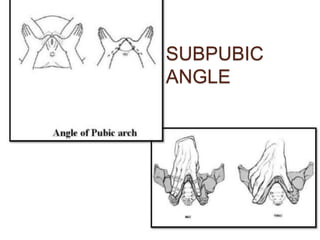 SUBPUBIC
ANGLE
 