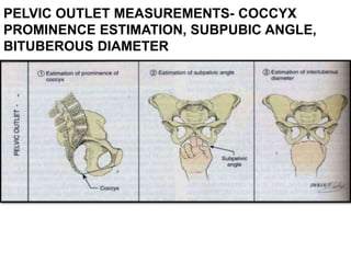PELVIC OUTLET MEASUREMENTS- COCCYX
PROMINENCE ESTIMATION, SUBPUBIC ANGLE,
BITUBEROUS DIAMETER
 