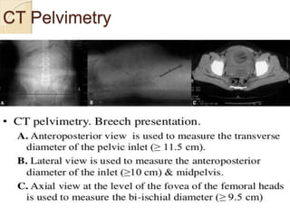 CT Pelvimetry
 