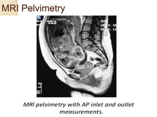 MRI Pelvimetry
 