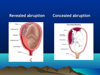 Revealed abruption Concealed abruption
 