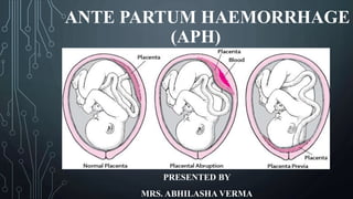 ANTE PARTUM HAEMORRHAGE
(APH)
PRESENTED BY
MRS. ABHILASHA VERMA
 