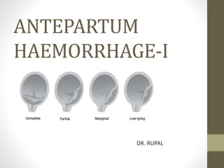 ANTEPARTUM
HAEMORRHAGE-I
DR. RUPAL
 