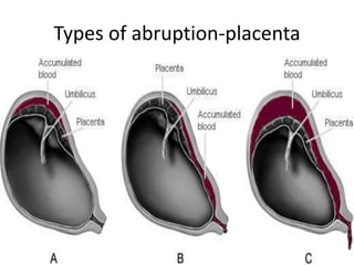 Types of abruption-placenta
 